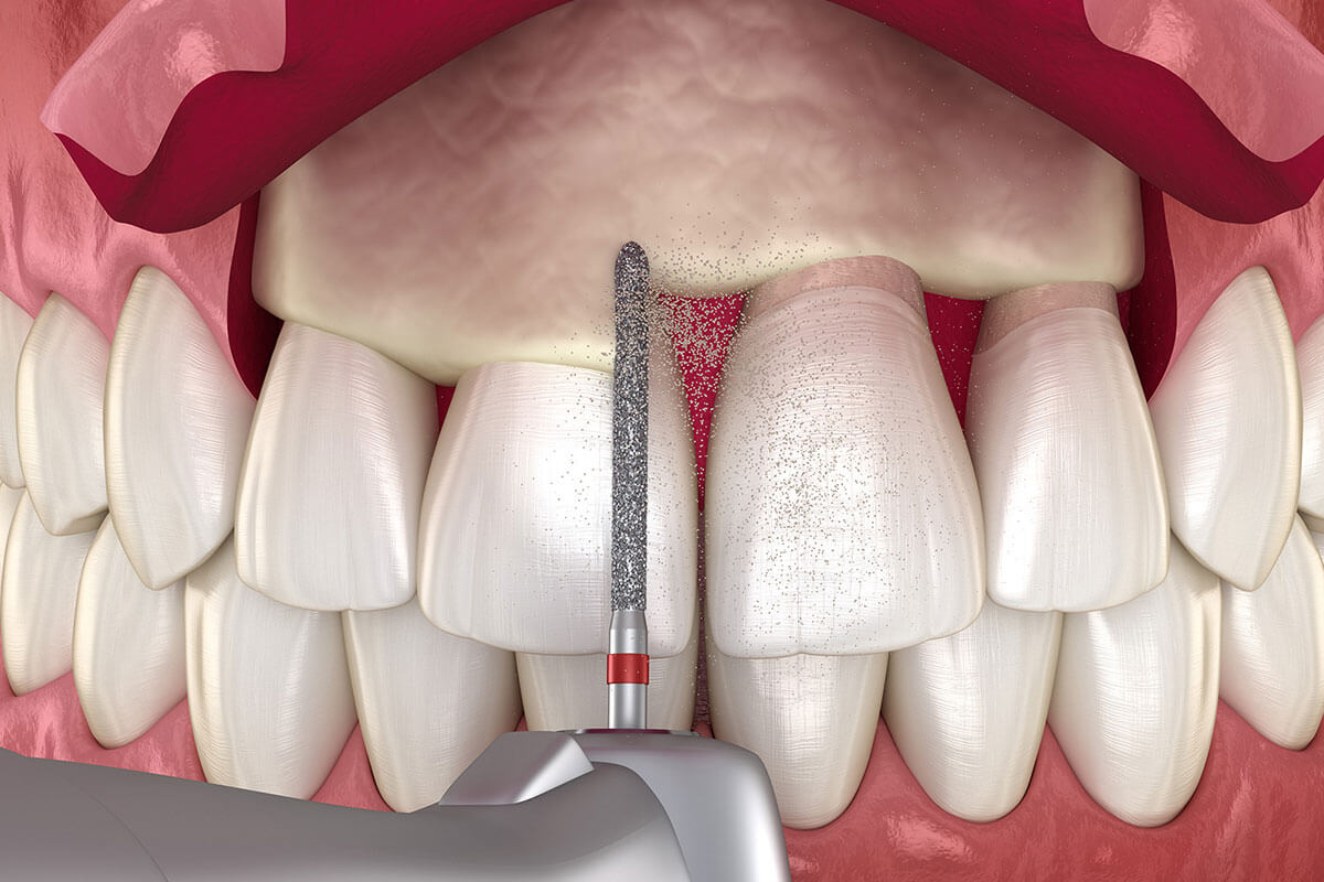 Crown Lengthening