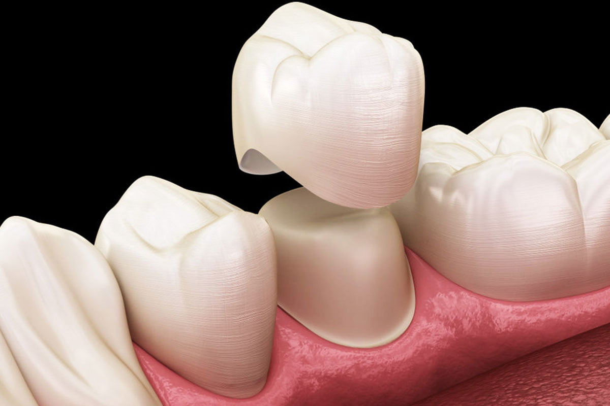 Dental Crowns