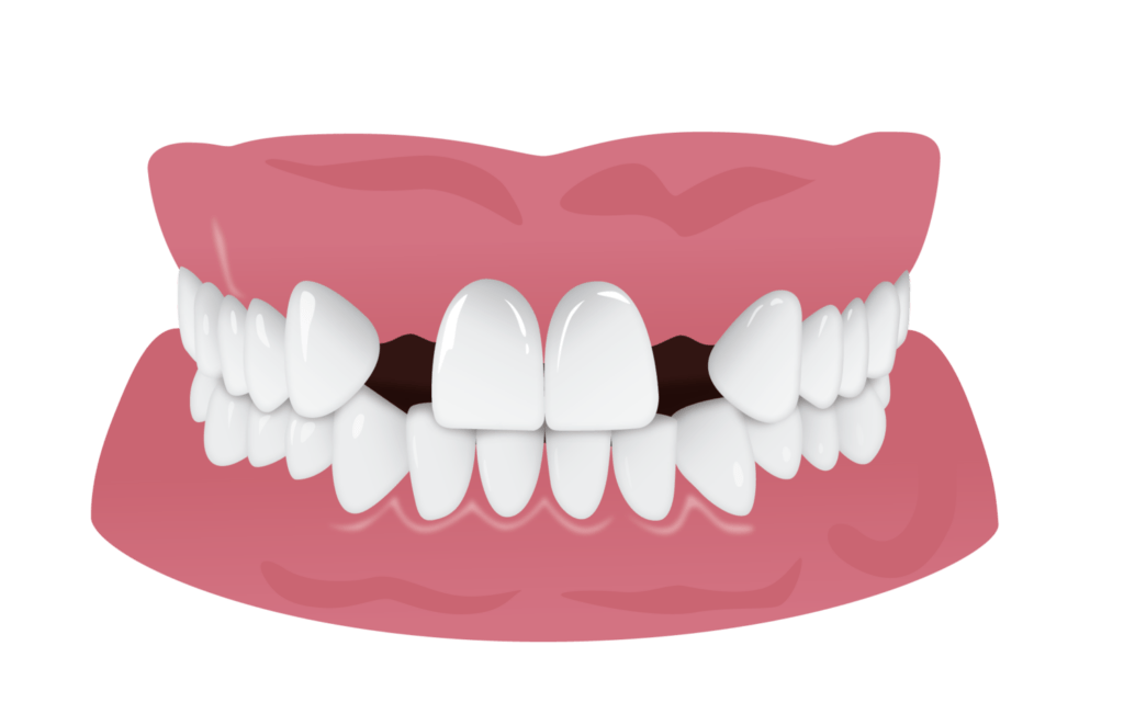 Hypodontia